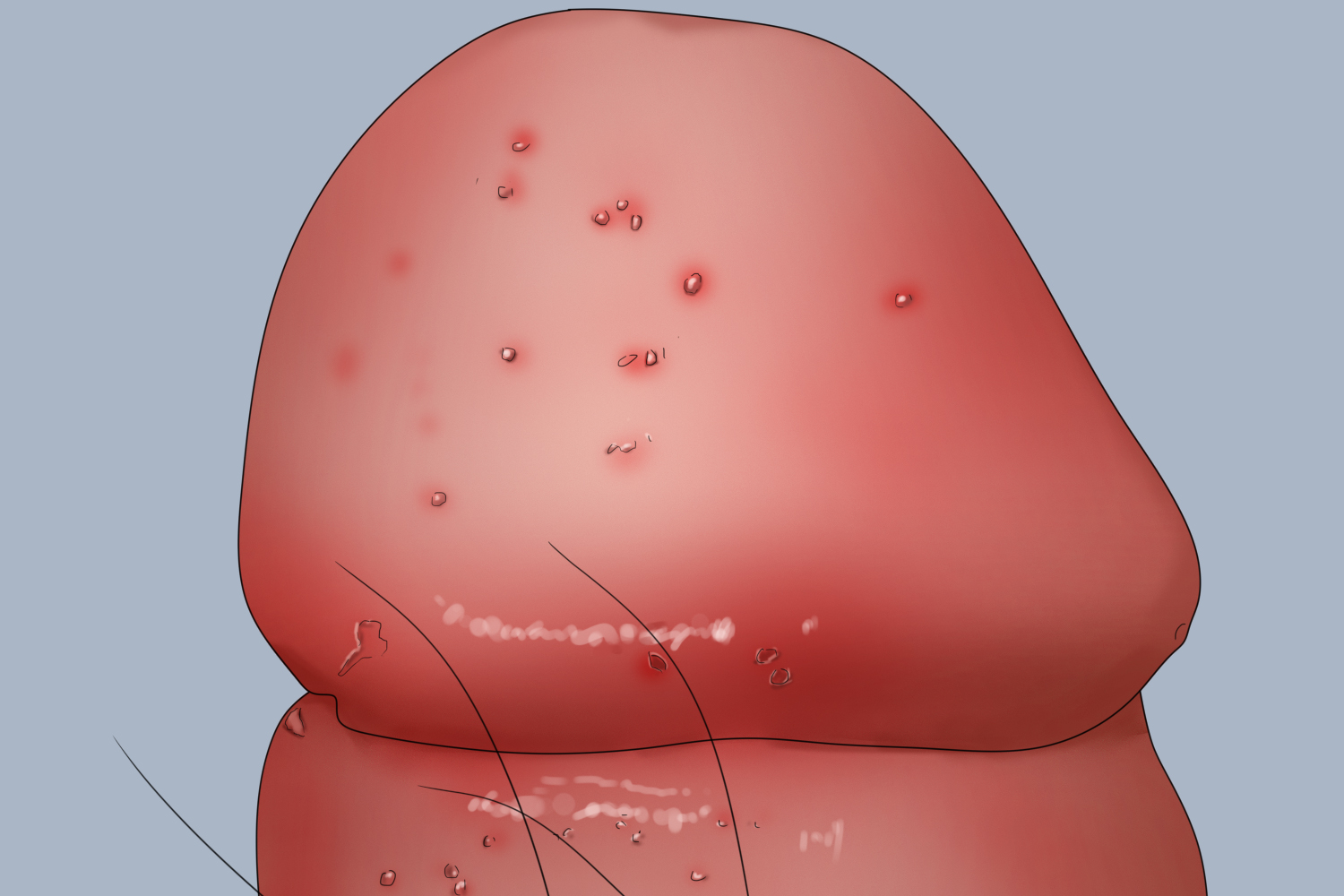 滴虫性龟头炎龟头小水疱手绘图 滴虫性龟头炎龟头小水疱手绘图