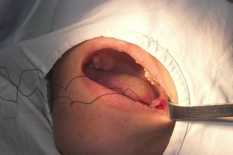 拔牙创口处理及缝合图 拔牙创口处理及缝合图