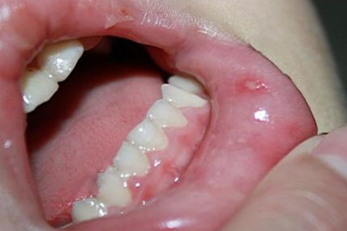 手足口病口腔黏膜疱疹图