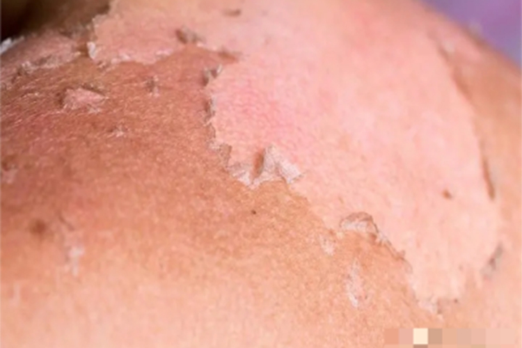 光接触性皮炎背部脱皮图