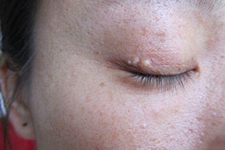 原发性粟丘疹眼睑小疙瘩图