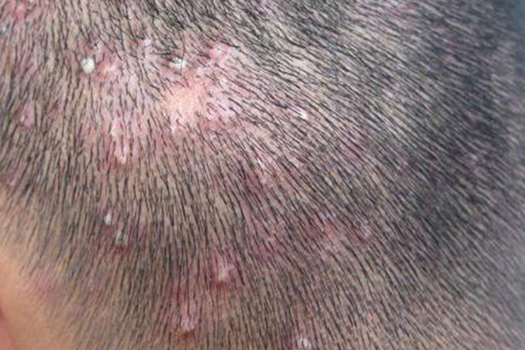 白塞病毛囊炎样皮损图