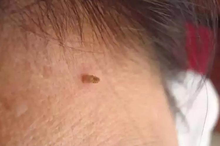 颈部丝状疣图片 颈部丝状疣图片