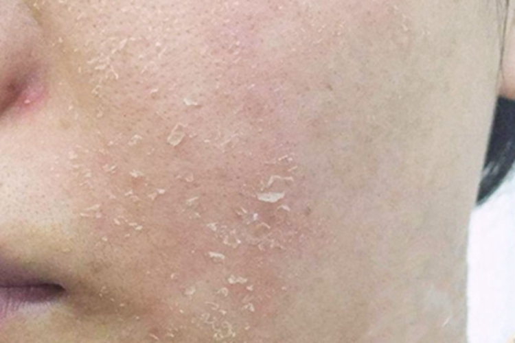 桥本甲状腺炎面部症状图 桥本甲状腺炎面部症状图