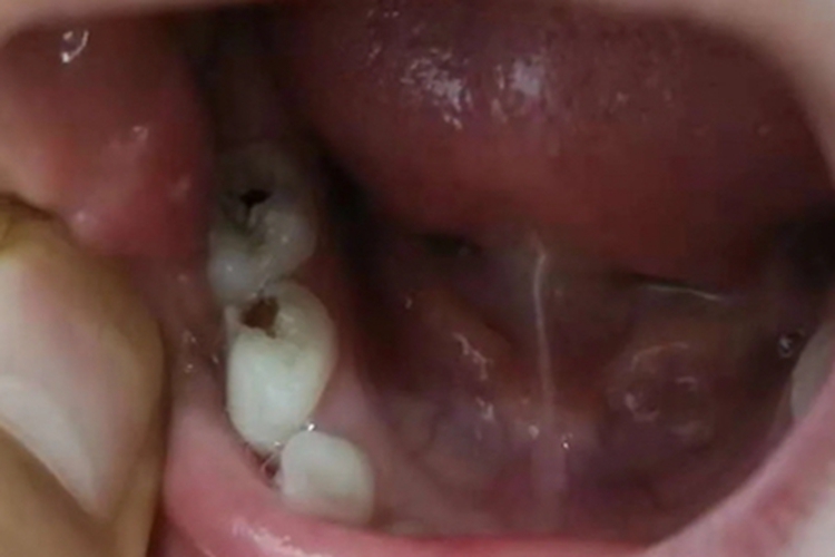 猖獗龋牙齿大窟窿图 猖獗龋牙齿大窟窿图