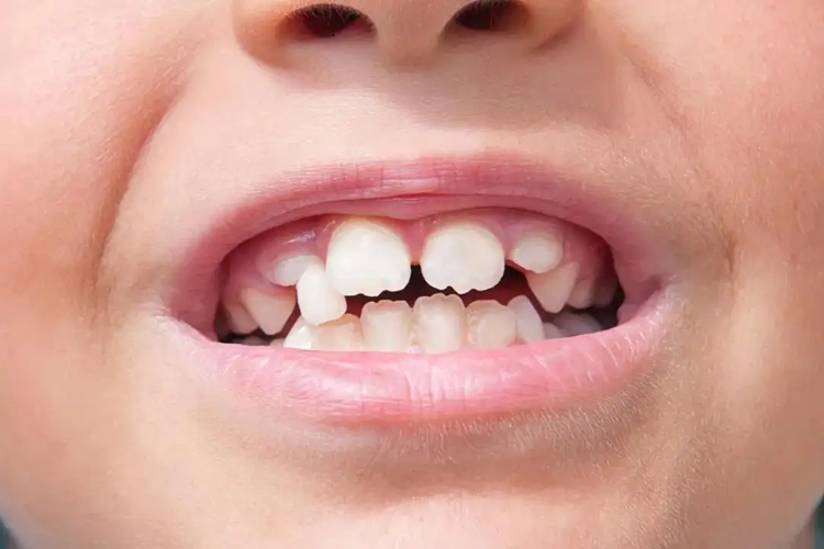 个别牙错位牙齿不平整图