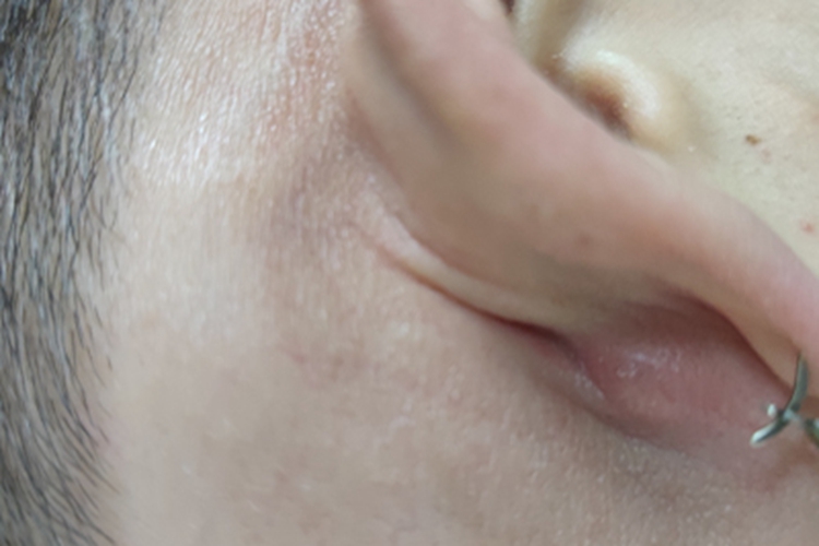 皮脂腺囊肿耳后疙瘩图 皮脂腺囊肿耳后疙瘩图