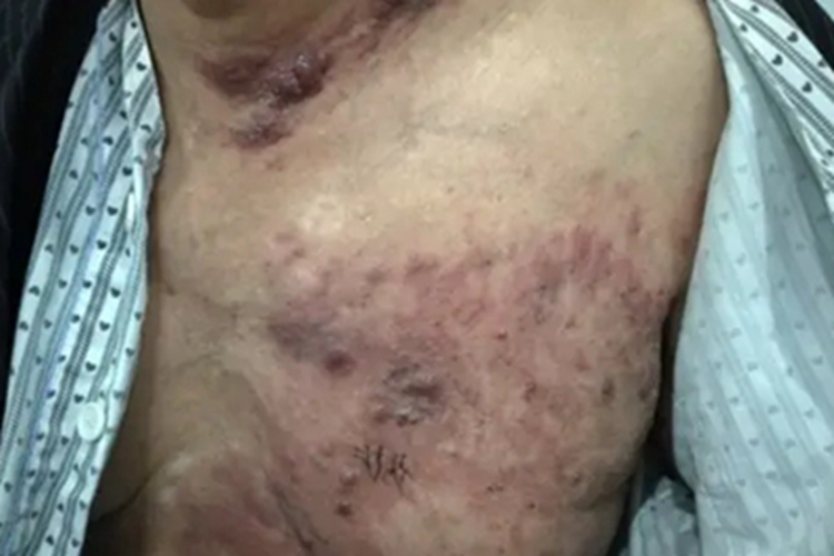 男性乳腺癌乳房结节图