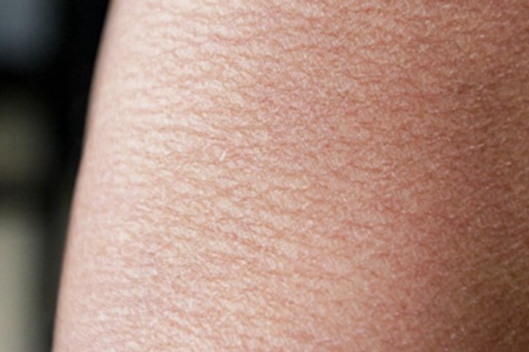 干燥综合征小腿脱屑图 干燥综合征小腿脱屑图