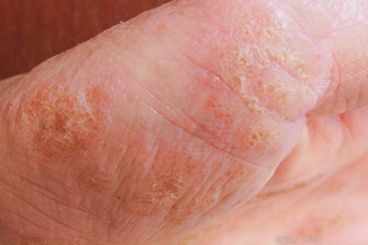 脓疱性细菌疹手部结痂图