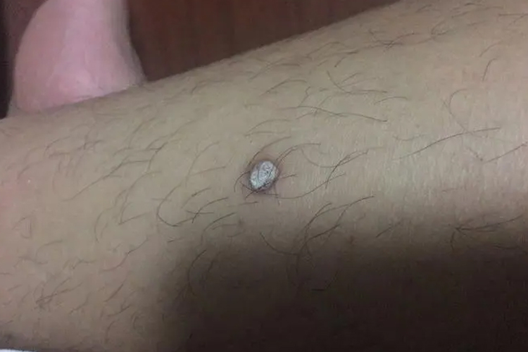 大腿寻常疣图 大腿寻常疣图