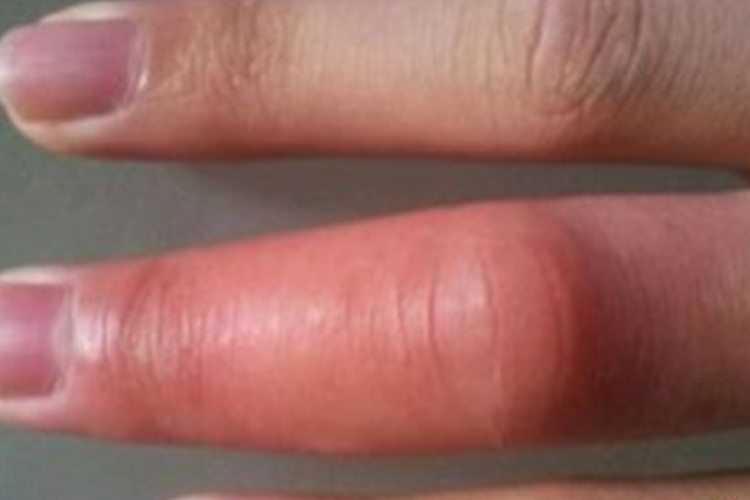 马蜂蜇伤红肿图