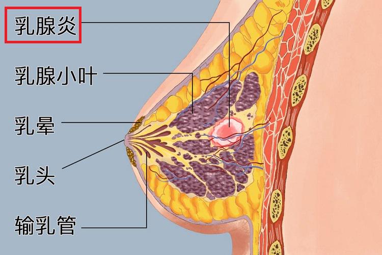 急性乳腺炎手绘图