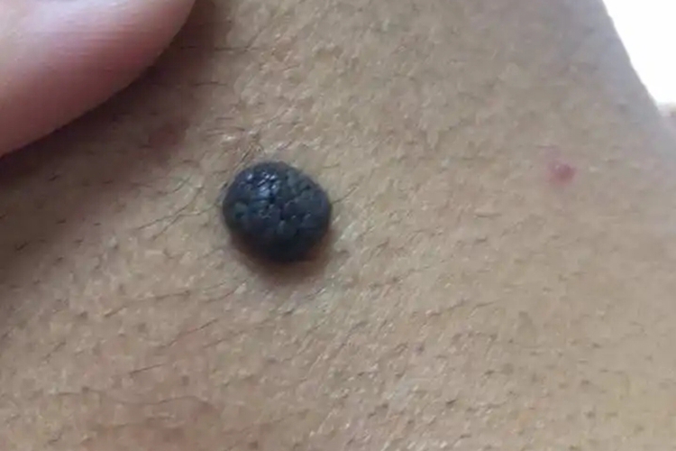 皮内痣后颈疙瘩图