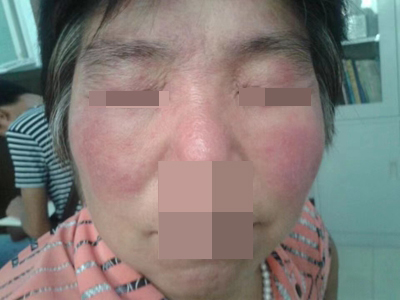 面部皮炎脸颊泛红图-有来医生