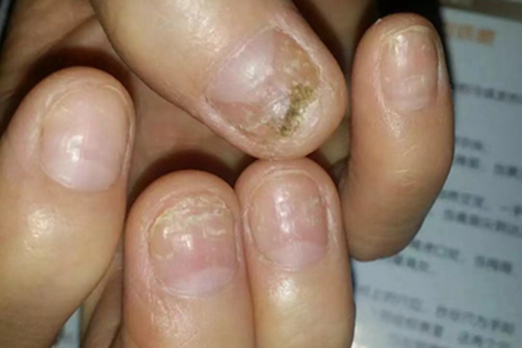 远端侧位甲下型手指甲症状图