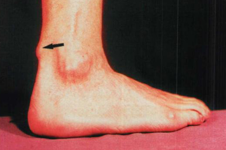 类风湿关节炎类风湿结节图