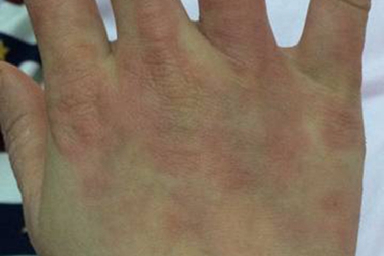 重症多形红斑手背症状图 重症多形红斑手背症状图