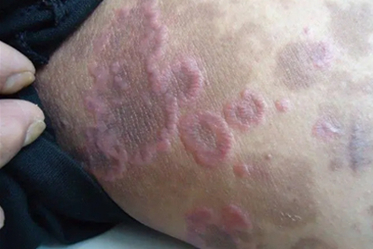 扁平苔藓大腿症状图 扁平苔藓大腿症状图