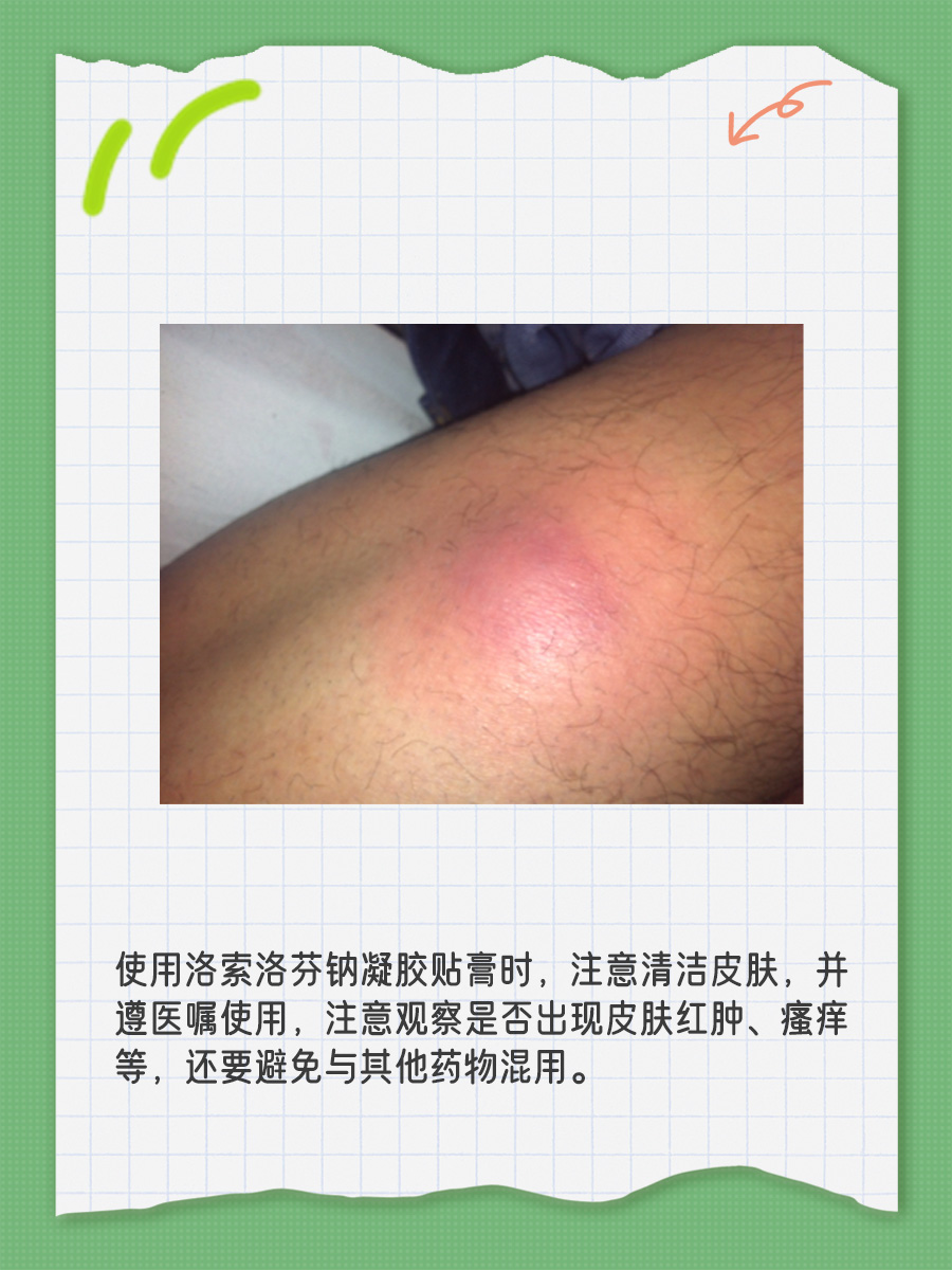 洛索洛芬钠凝胶贴膏，一盒价格大揭秘！