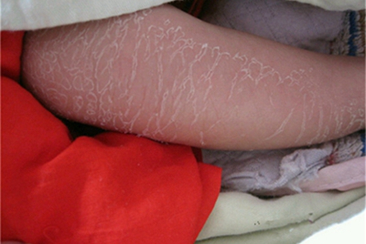 寻常型鱼鳞病小腿脱皮图 寻常型鱼鳞病小腿脱皮图