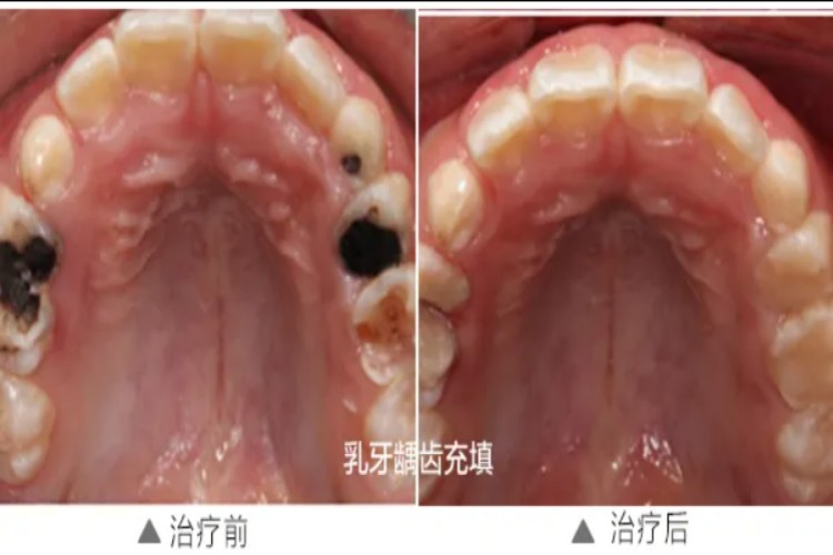 儿童龋病治疗前后对比图