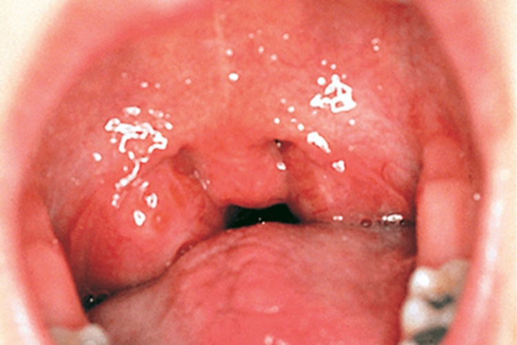 急性扁桃体炎扁桃体肉球图 急性扁桃体炎扁桃体肉球图