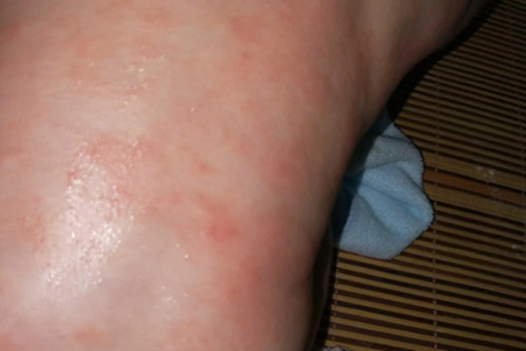 奶癣初期症状图