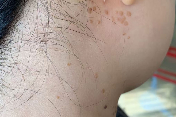 脖子上扁平疣图 脖子上扁平疣图