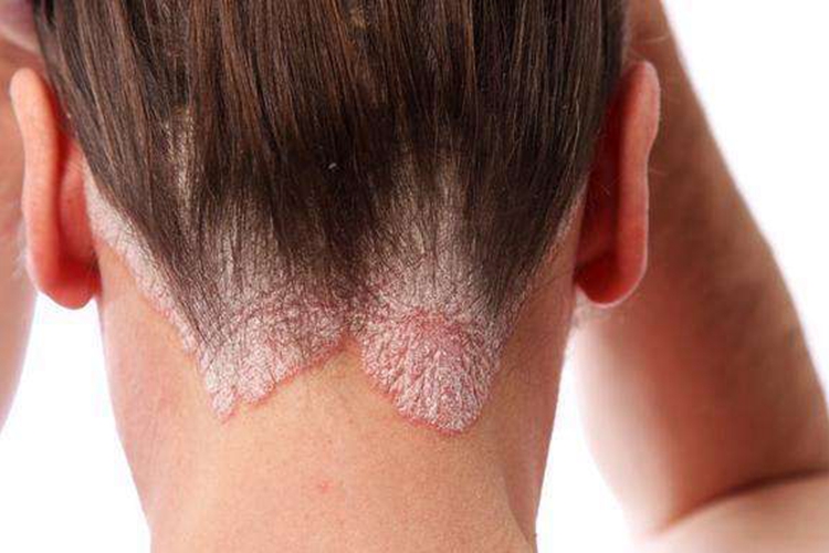 银屑病头皮鳞屑图