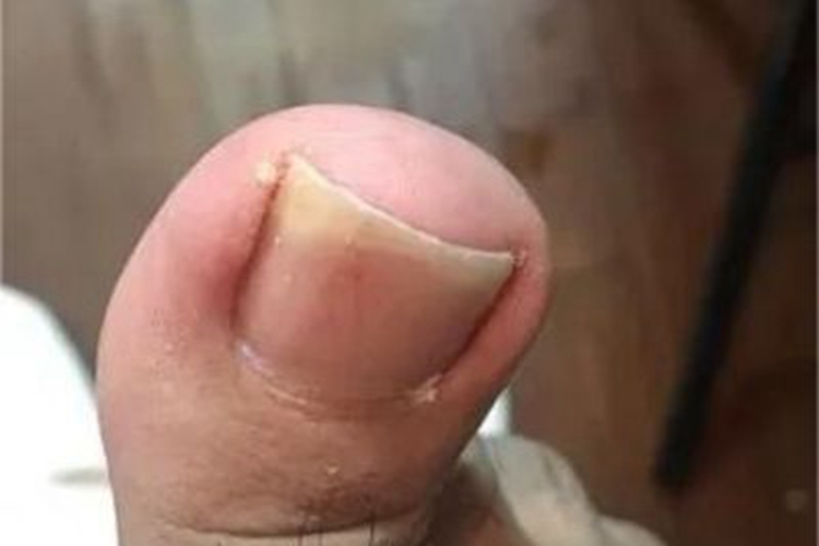 慢性甲沟炎脚趾头红肿图