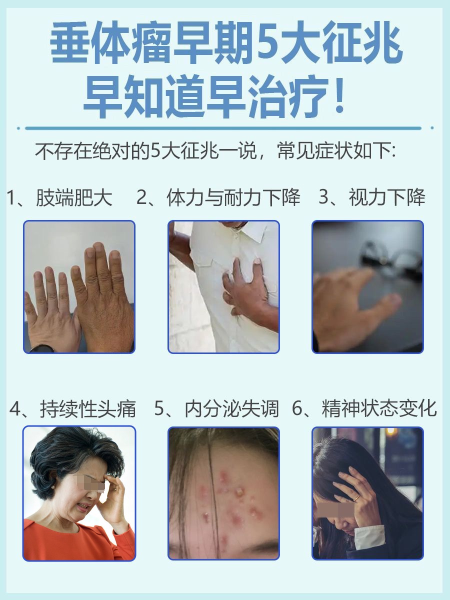 垂体瘤早期5大征兆，早知道早治疗！