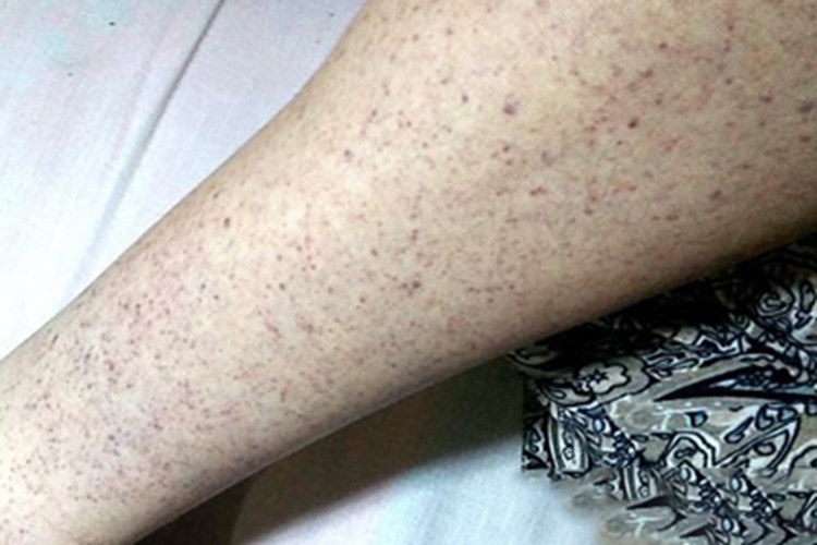 血栓性血小板减少性紫癜紫斑图 血栓性血小板减少性紫癜紫斑图