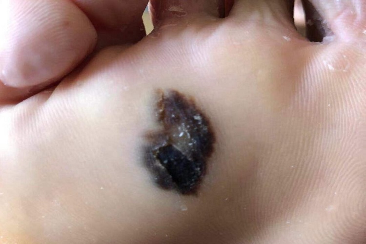 肢端雀斑痣样黑素瘤长瘤图 肢端雀斑痣样黑素瘤长瘤图