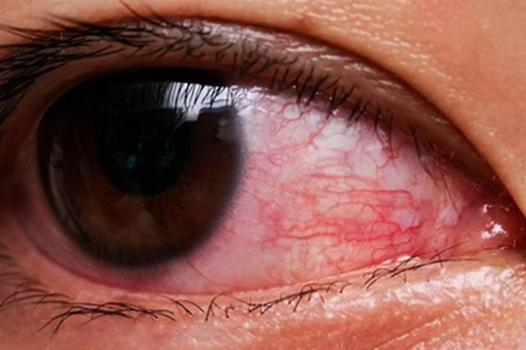 流行性角结膜炎结膜症状图