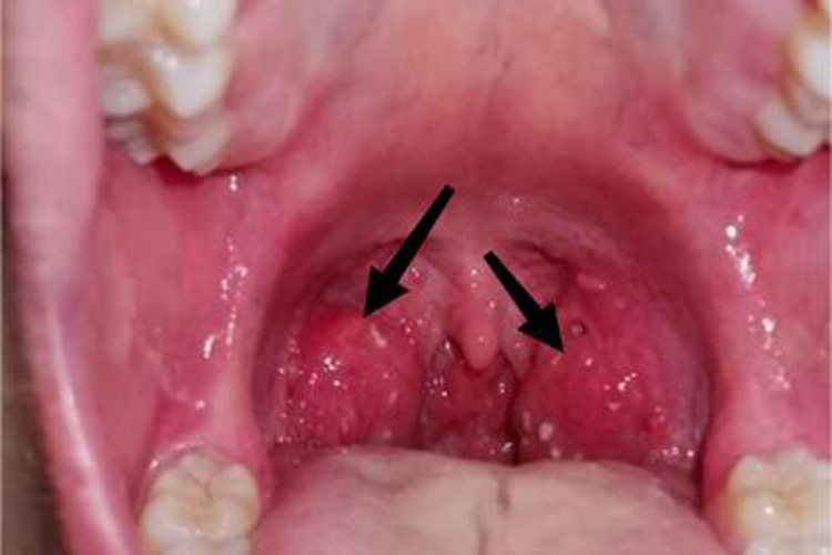 淋菌性咽炎充血图