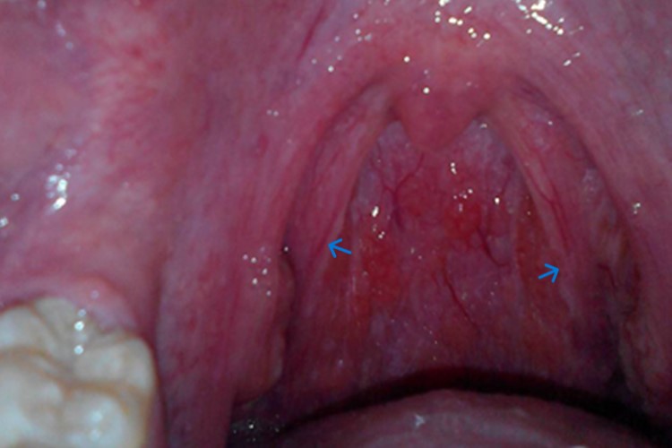 扁桃体纤维化图 扁桃体纤维化图