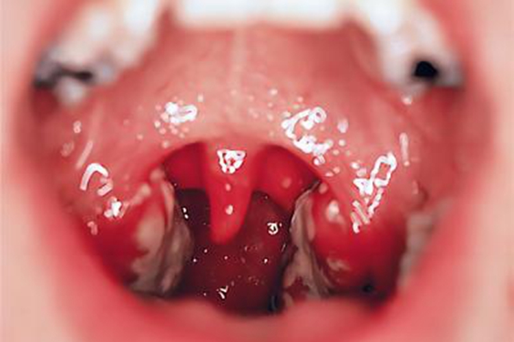 急性隐窝性扁桃体炎有白色小点图