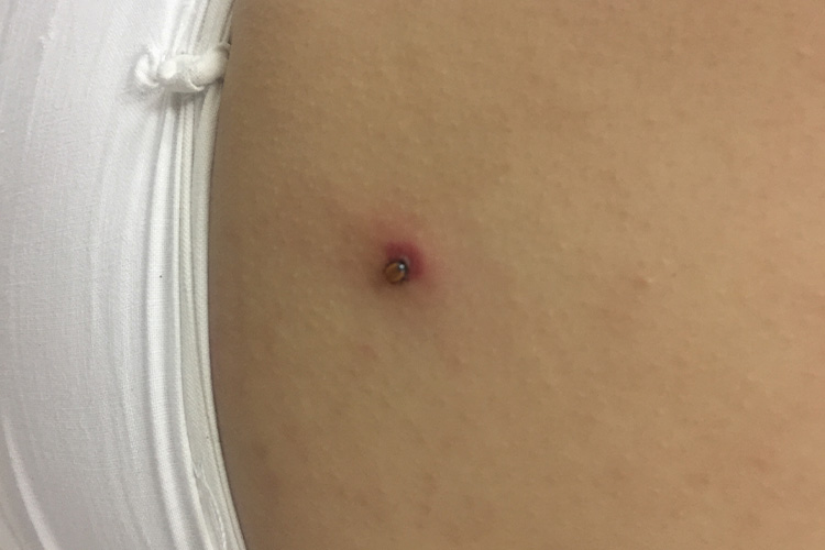 蜱叮咬后皮损图