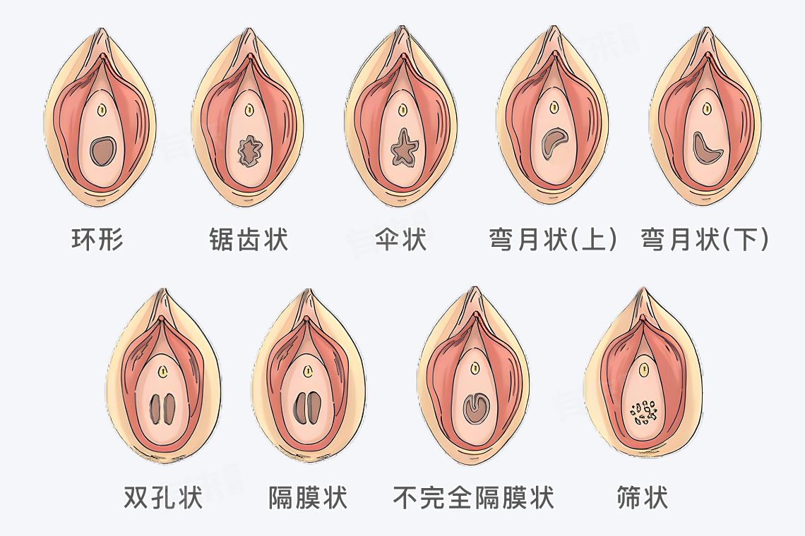 处女膜长什么样？