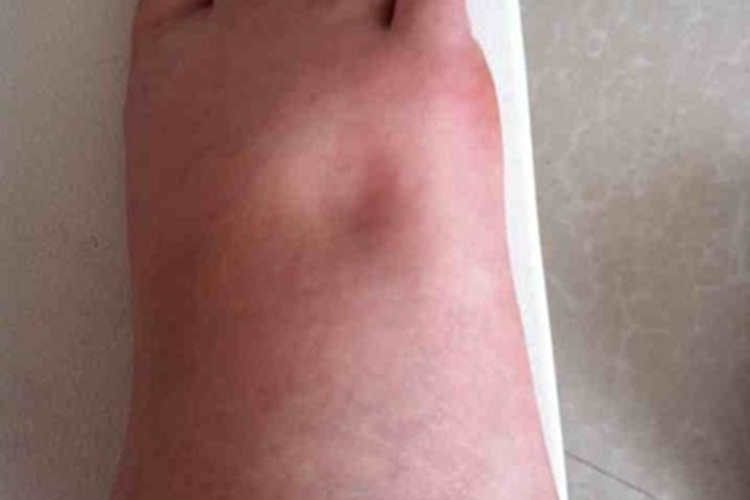 旋毛虫病脚部肿图