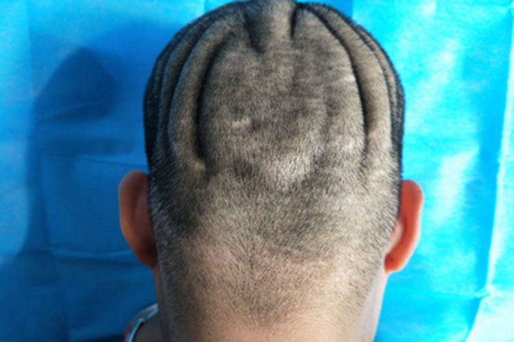 原发性骨膜增生厚皮症皮肤增厚图