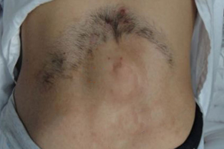 小儿脊髓栓系综合征症状图