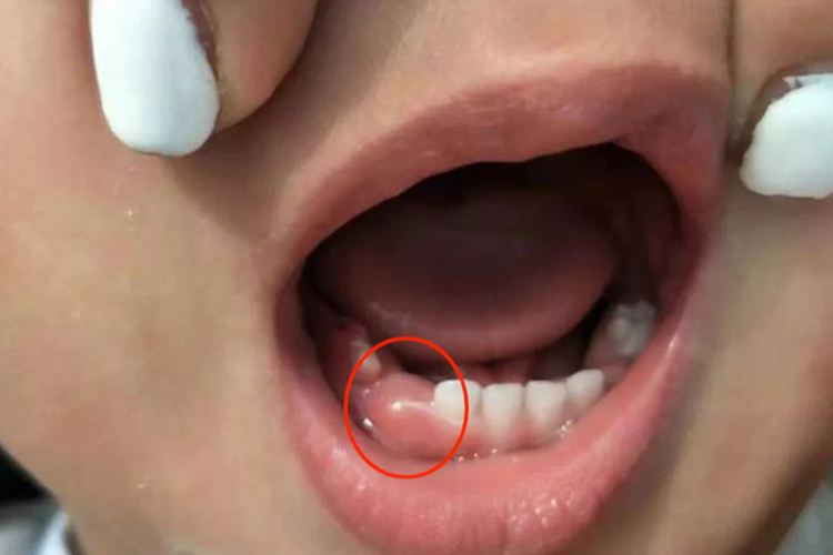 1岁宝宝萌出性龈炎图