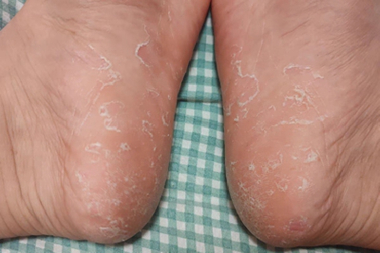 水疱型足癣脚后跟症状图 水疱型足癣脚后跟症状图
