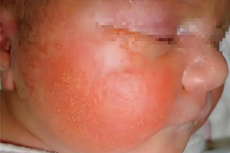 新生儿毒性红斑面部红斑有丘疹图 新生儿毒性红斑面部红斑有丘疹图