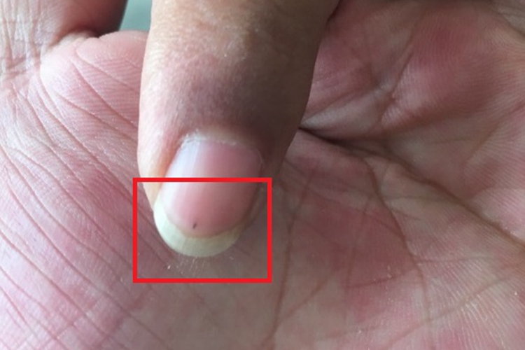刺伤手指甲黑点图 刺伤手指甲黑点图