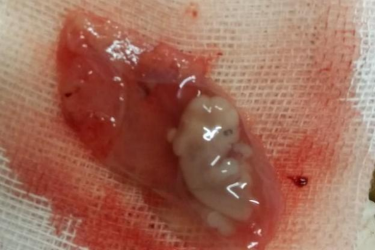 35天左右药流孕囊图 35天左右药流孕囊图