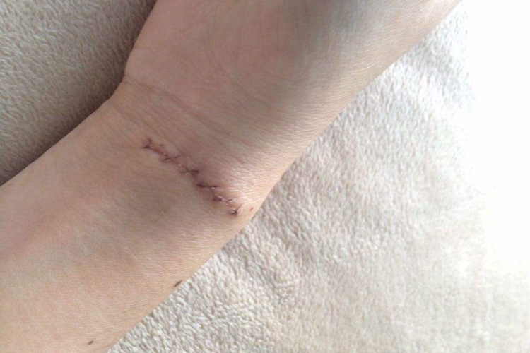 手腕缝针轻度增生疤痕图