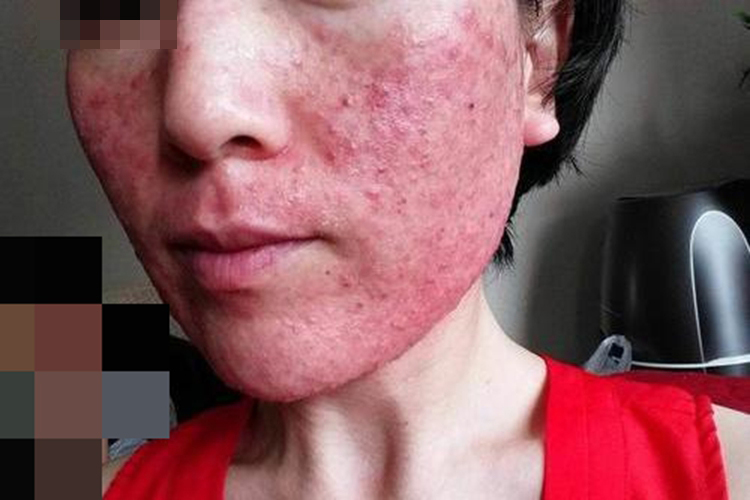 激素脸结痂掉后的图 激素脸结痂掉后的图